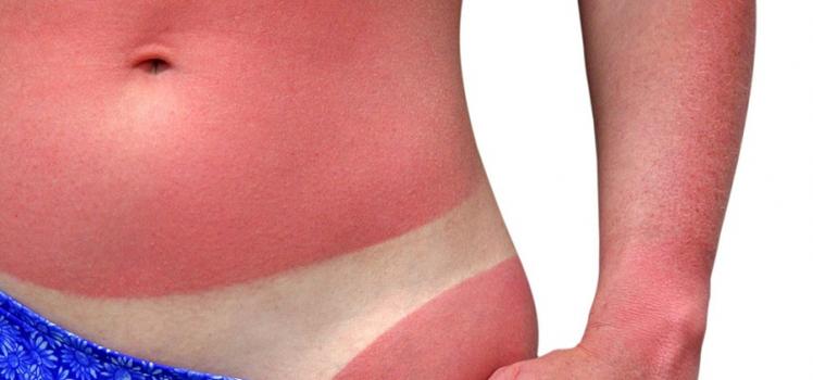 Cum și cu ce să tratezi acasă pielea arsă de soare