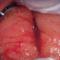 Cervicita colului uterin: simptome și tratament, cauze de apariție Cum să vă protejați de boală
