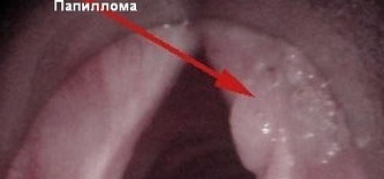 Папиллома в горле: причины, признаки (фото), как лечить, удаление
