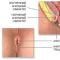 Šta uzrokuje analni svrab i šta učiniti ako nepodnošljivo svrbi u anusu?
